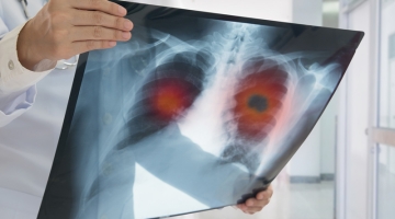 National Lung Cancer Screening