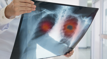 National Lung Cancer Screening session 2