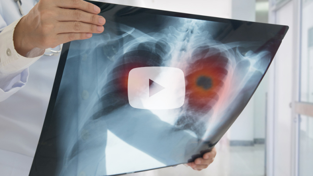 National Lung Cancer Screening session 2